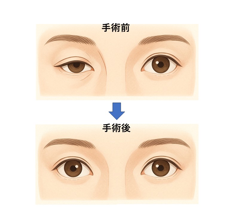 眼瞼下垂症の手術イメージ